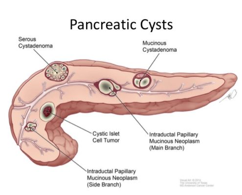 Nang tụy - Hình ảnh minh họa